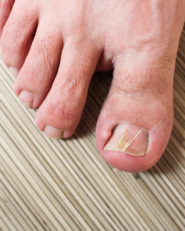Ingrown Toenail Treatment Dr Shazia