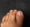 Ingrown Toenail Treatment in Montreal