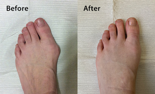 foot surgery before after
